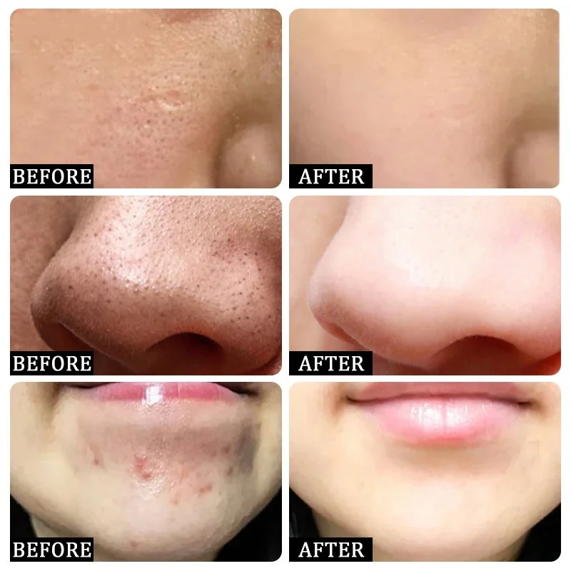 Salicylzuur Porie Clearing Cre - Salicylic Acid Blackhead Remover recensie en prijs